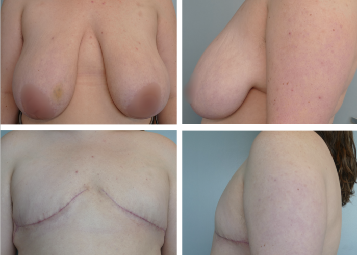 top surgery results